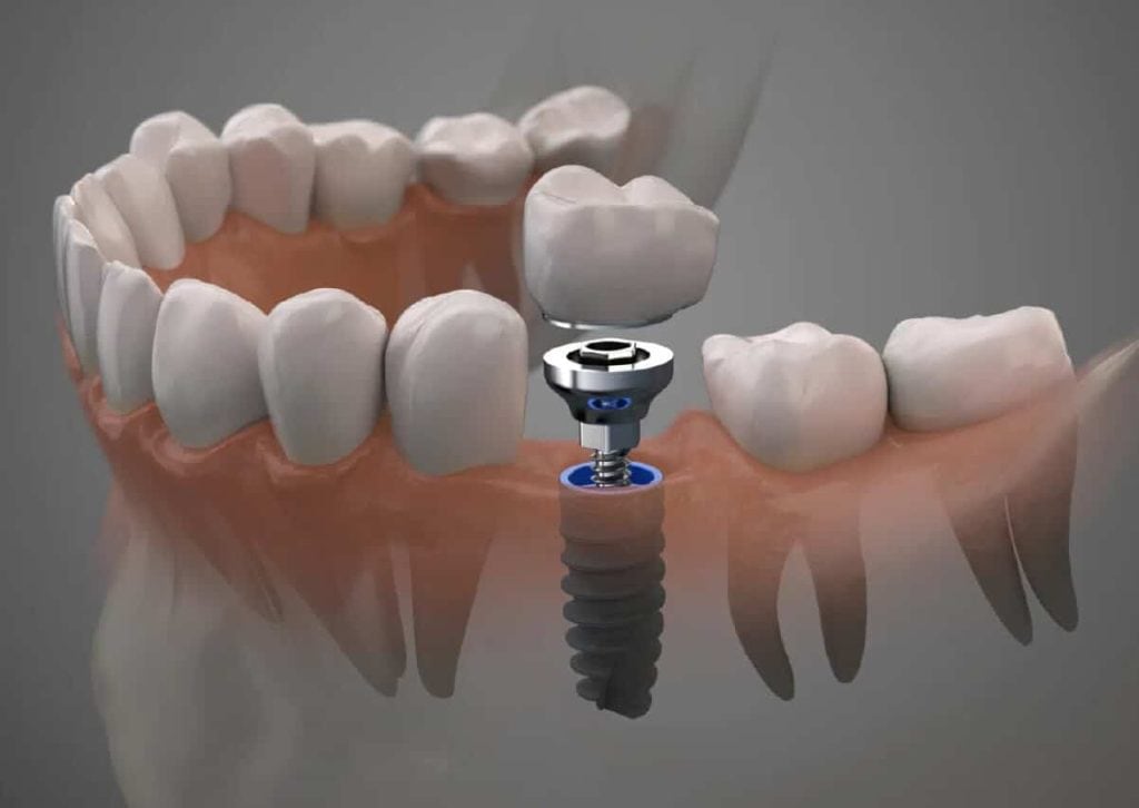 Ilustración de un implante dental integrado en el hueso