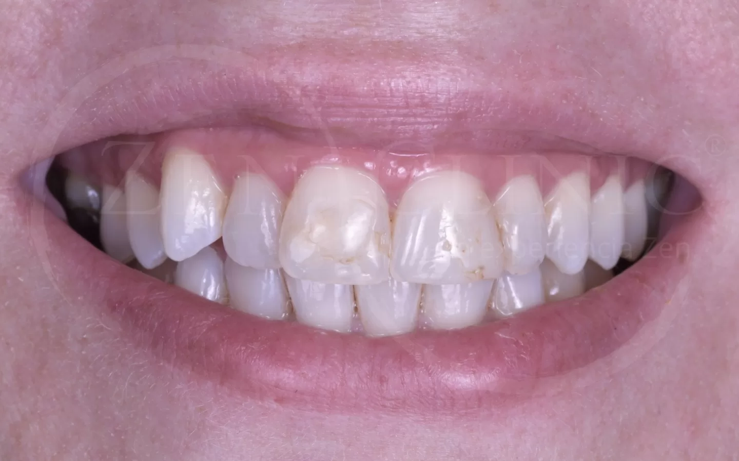 Antes