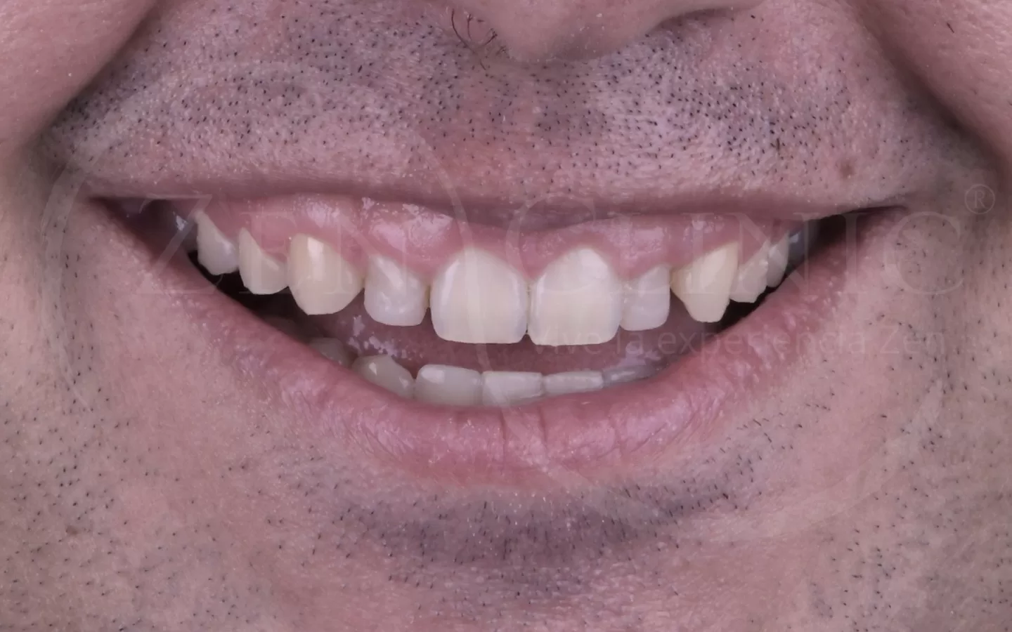 Antes