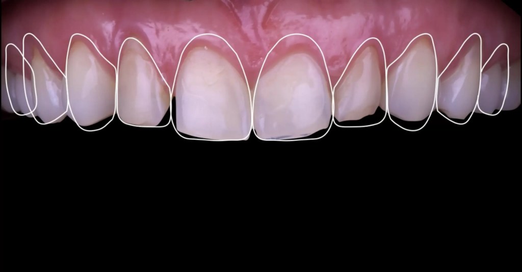 Planificación y diseño digital de sonrisa con software especializado