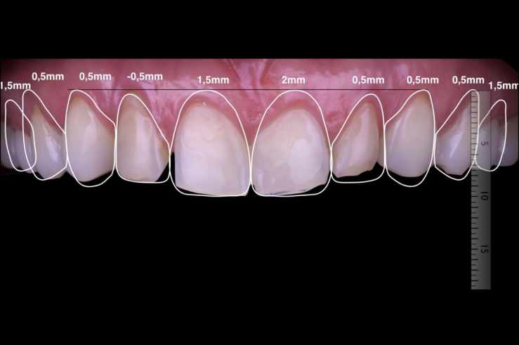 ¿Cómo funciona el Diseño de Sonrisa?