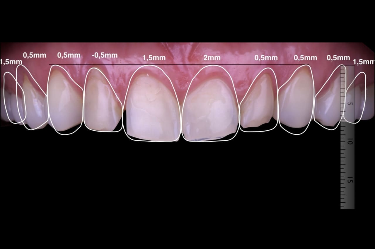 ¿Cómo funciona el Diseño de Sonrisa?