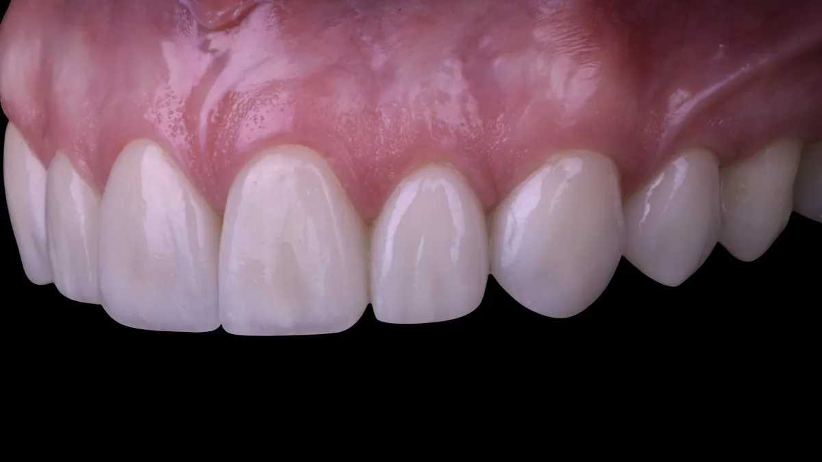 Resultado de rehabilitación oral con restauraciones cerámicas en los dientes anteriores superiores, caso de Zenclinic Dental en La Dehesa