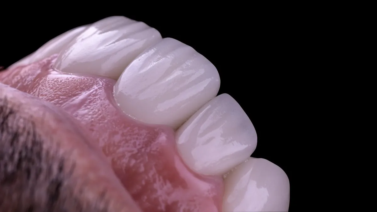 Vista oblicua de restauraciones cerámicas en los dientes anteriores superiores, caso de rehabilitación oral de Zenclinic Dental en La Dehesa